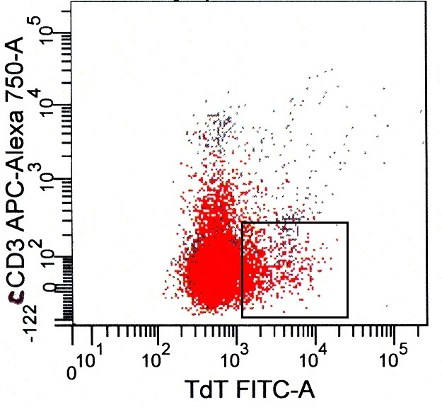 Figure 7d: Flow cytometry (cont.). Two blast population subsets with differing HLA-DR and CD99 expression. Very dim cCD3 and TdT positive subsets are seen. Blasts are negative for MPO.
